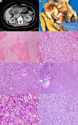 De novo dedifferentiated SDH-deficient gastrointestinal stromal tumor with MDM2 amplification: case report and literature review
